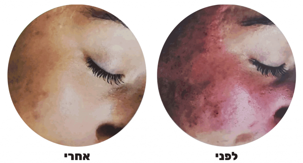 פיגמנטציה PIGMENTATION